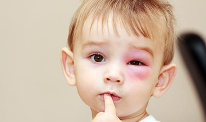 Kind mit rot geschwollenem Auge